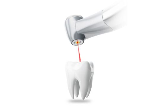 Laser Dental Fillings