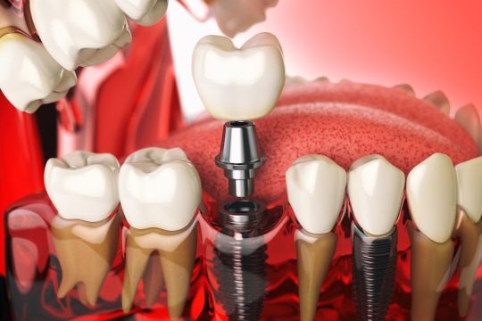 Bone Grafting and Sinus Lifts Bone Grafting and Sinus Lifts